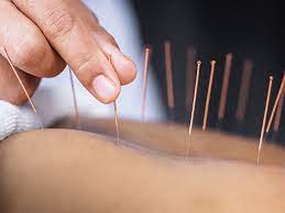 Acupuncture & Sound Bath - Last Wednesday of the Month - 7pm