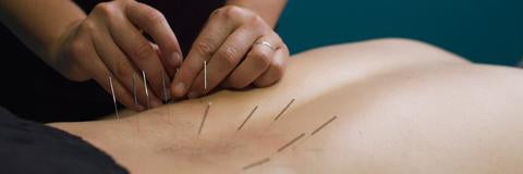 ACUPUNCTURE